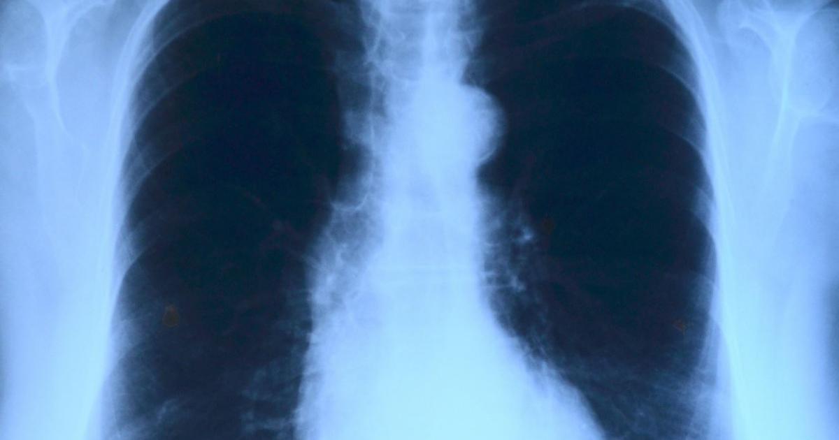 AI specialists gain CE mark approval for chest x-ray solution