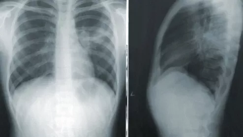 Chest X-ray. Using an explainable artificial intelligence (AI) model, researchers were recently able to accomplish highly accurate labeling on large datasets of publicly available chest radiograph X-rays.. 