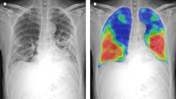 thirona x-ray image