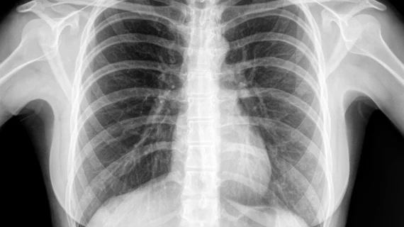 Chest x-ray